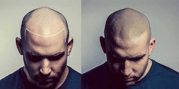 scalp micro pigmentation in Phuket, Thailand
