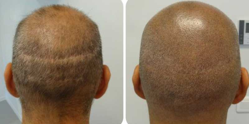 Scalp Micro Pigmentation in Phuket, Thailand