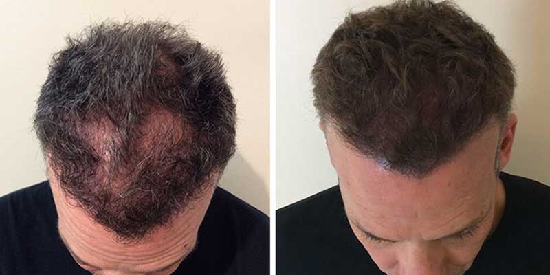 Scalp Micro Pigmentation in Phuket, Thailand