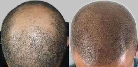 Scalp Micro Pigmentation in Phuket, Thailand